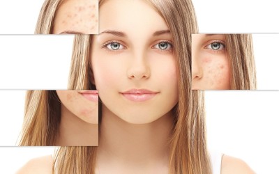 Tratamiento del acne sin receta medica