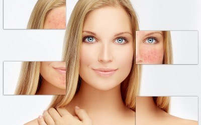 Rojeces y cuperosis o rosacea