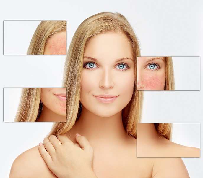 Rojeces y cuperosis o rosacea