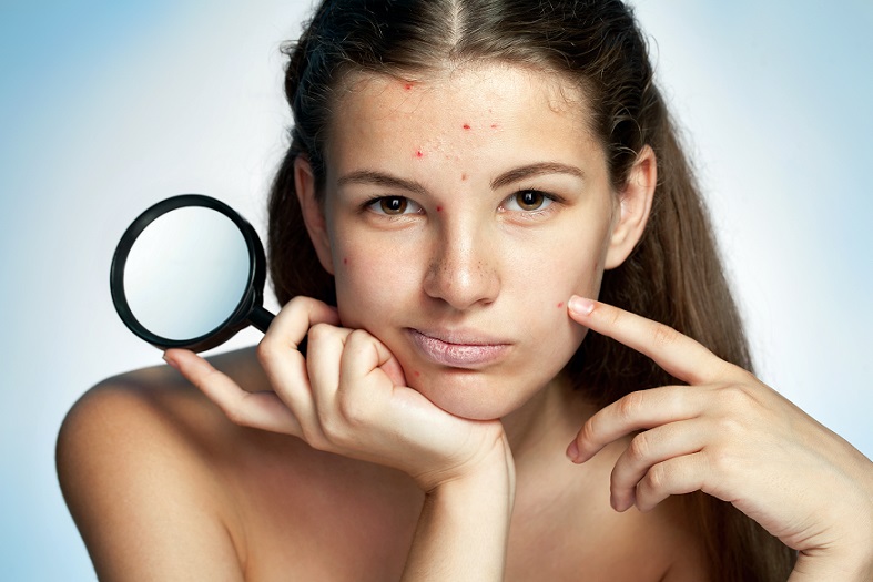 Mitos sobre los cosmecéuticos para acné