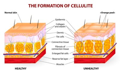 ¿QUE ES LA CELULITIS y COMO SE TRATA?