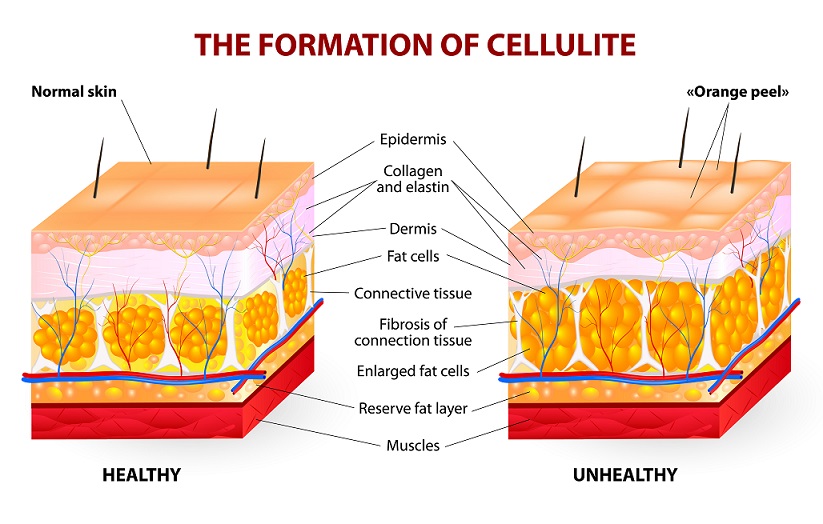 ¿QUE ES LA CELULITIS y COMO SE TRATA?